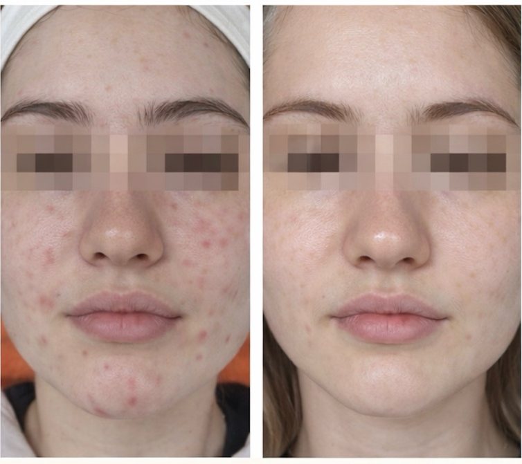 Gesicht einer jungen Frau, Augen verdeckt, vor und nach acht Wochen Anwendung