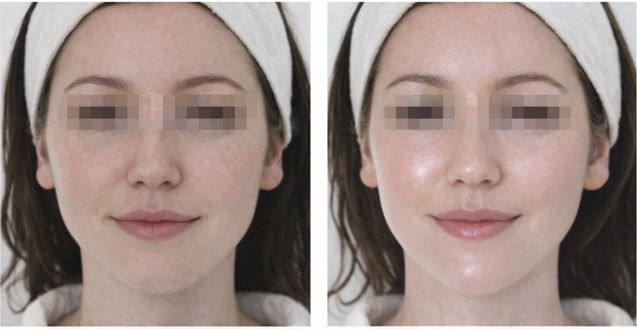 Viso di donna, con gli occhi oscurati, prima e dopo quattro settimane di utilizzo